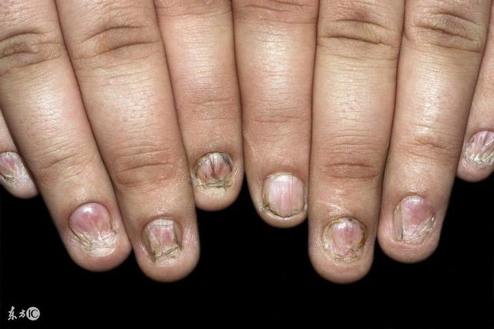 什么是灰指甲图片,灰指甲的前期症状是什么样子的