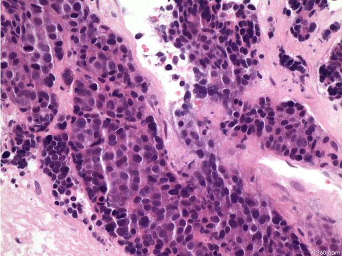 鳞状细胞癌图片,癌细胞的主要种类