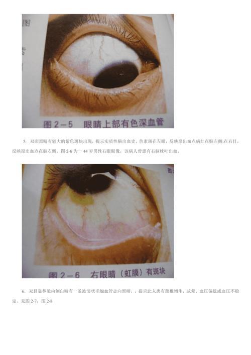 瑶医目诊图,白眼球有一块黄斑，哪位网友是眼科医生的请看一下图片给解答一下，谢谢。